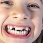 تسوس أسنان الأطفال