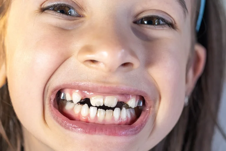 تسوس أسنان الأطفال