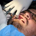 أسباب وطرق علاج كسور الفك