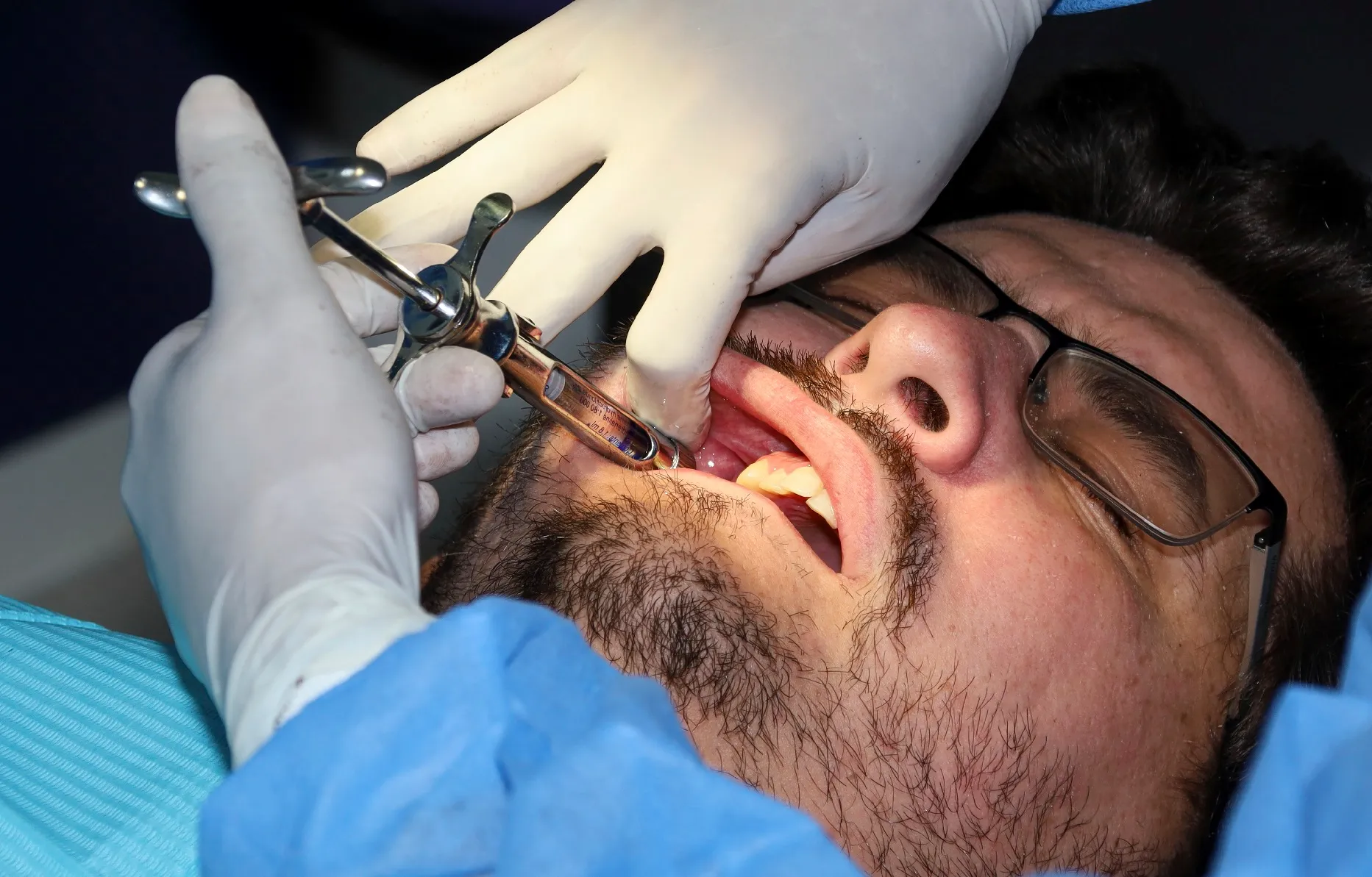 أسباب وطرق علاج كسور الفك