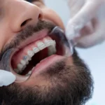 ترقيع اللثة