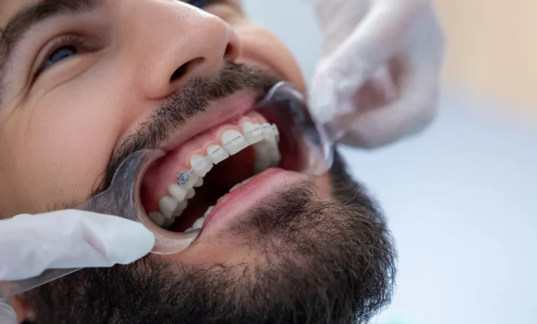 ترقيع اللثة