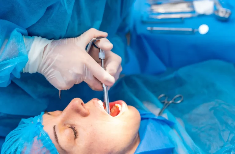 عملية زراعة اللثة