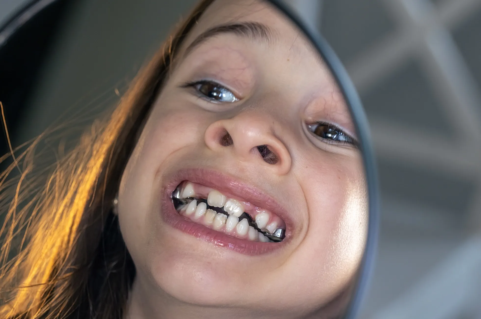 أسباب تسوس أسنان الأطفال