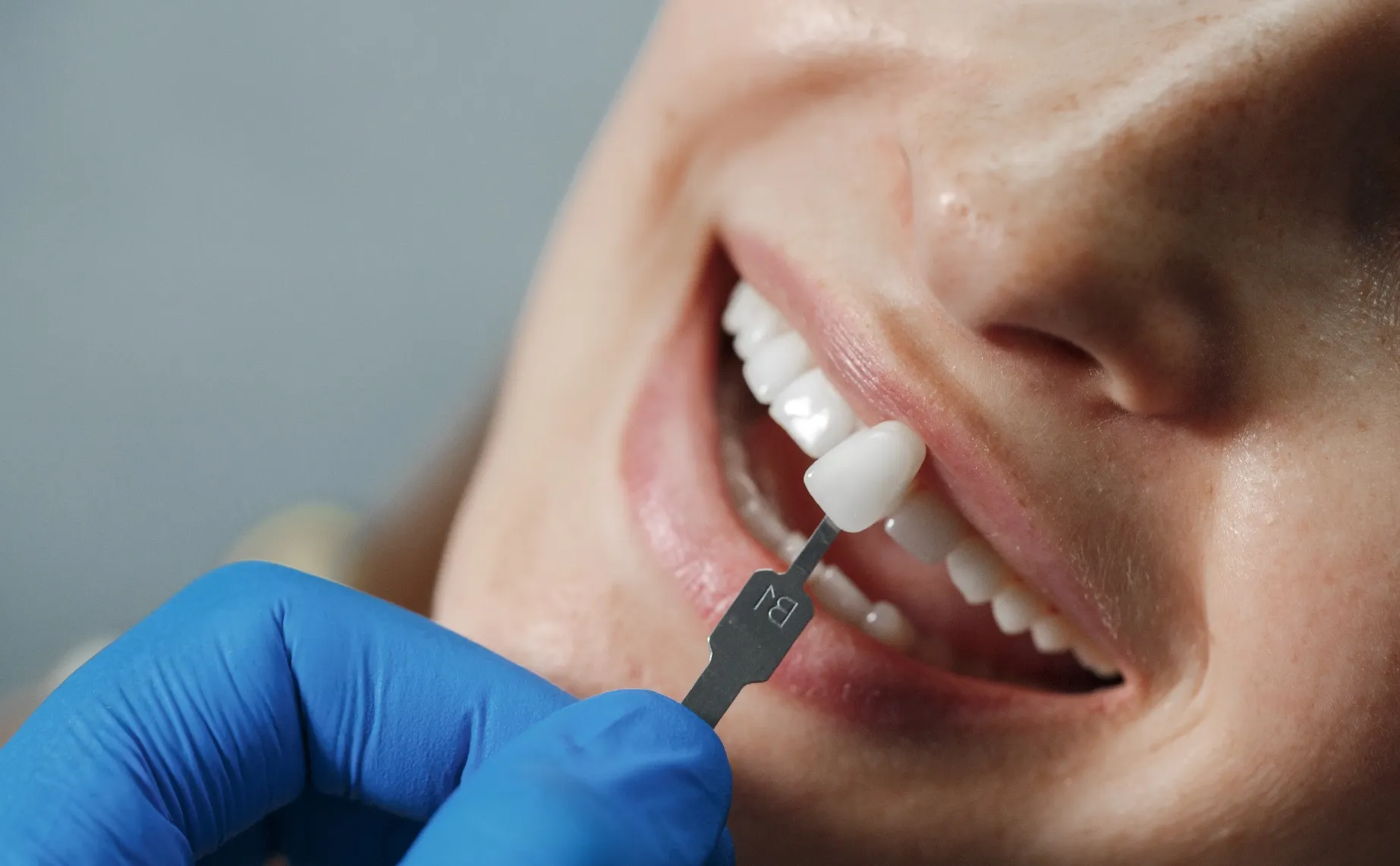 أنواع زراعة الأسنان