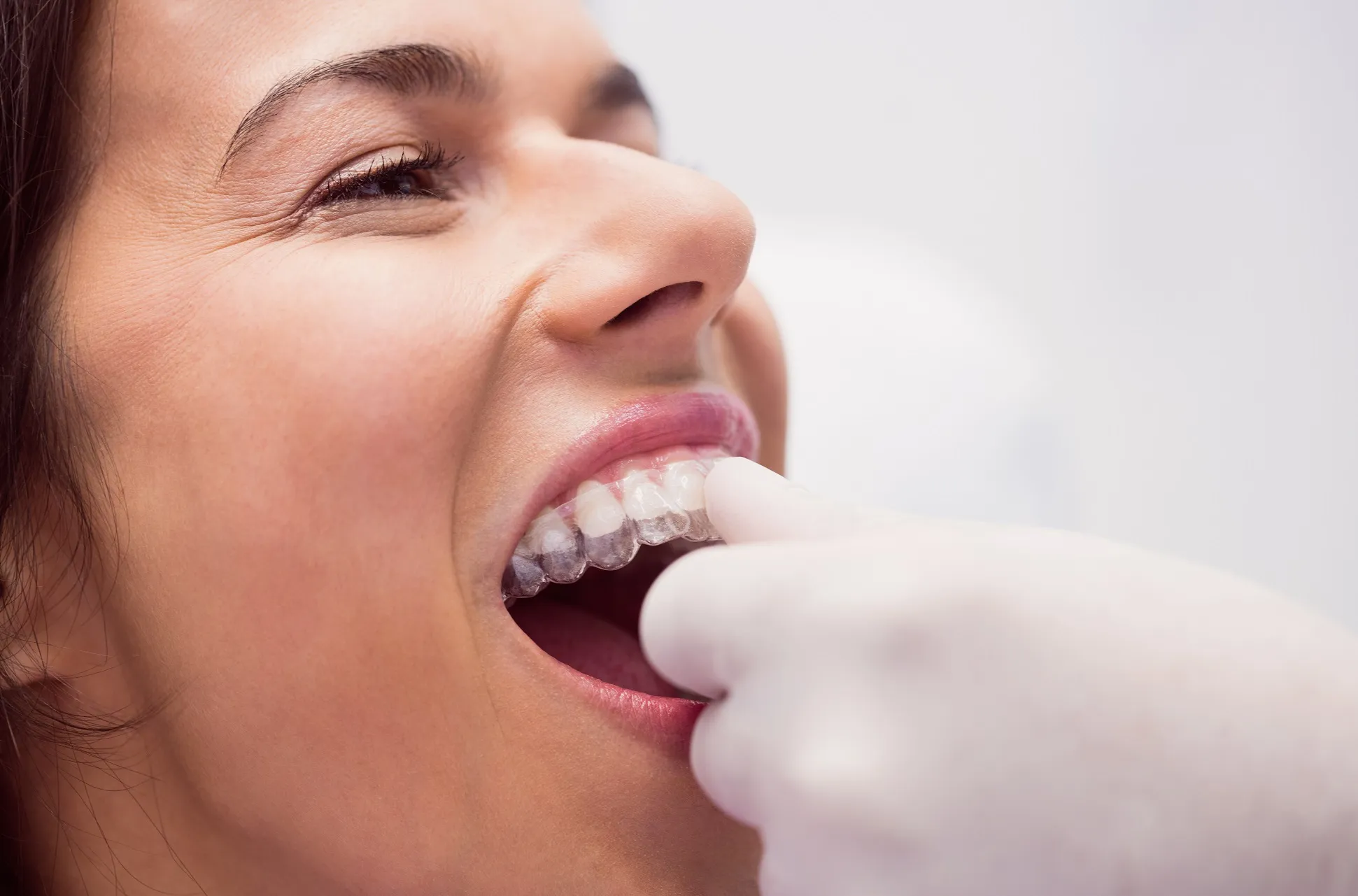 مميزات تقنيات تجميل الاسنان بدون تقويم 