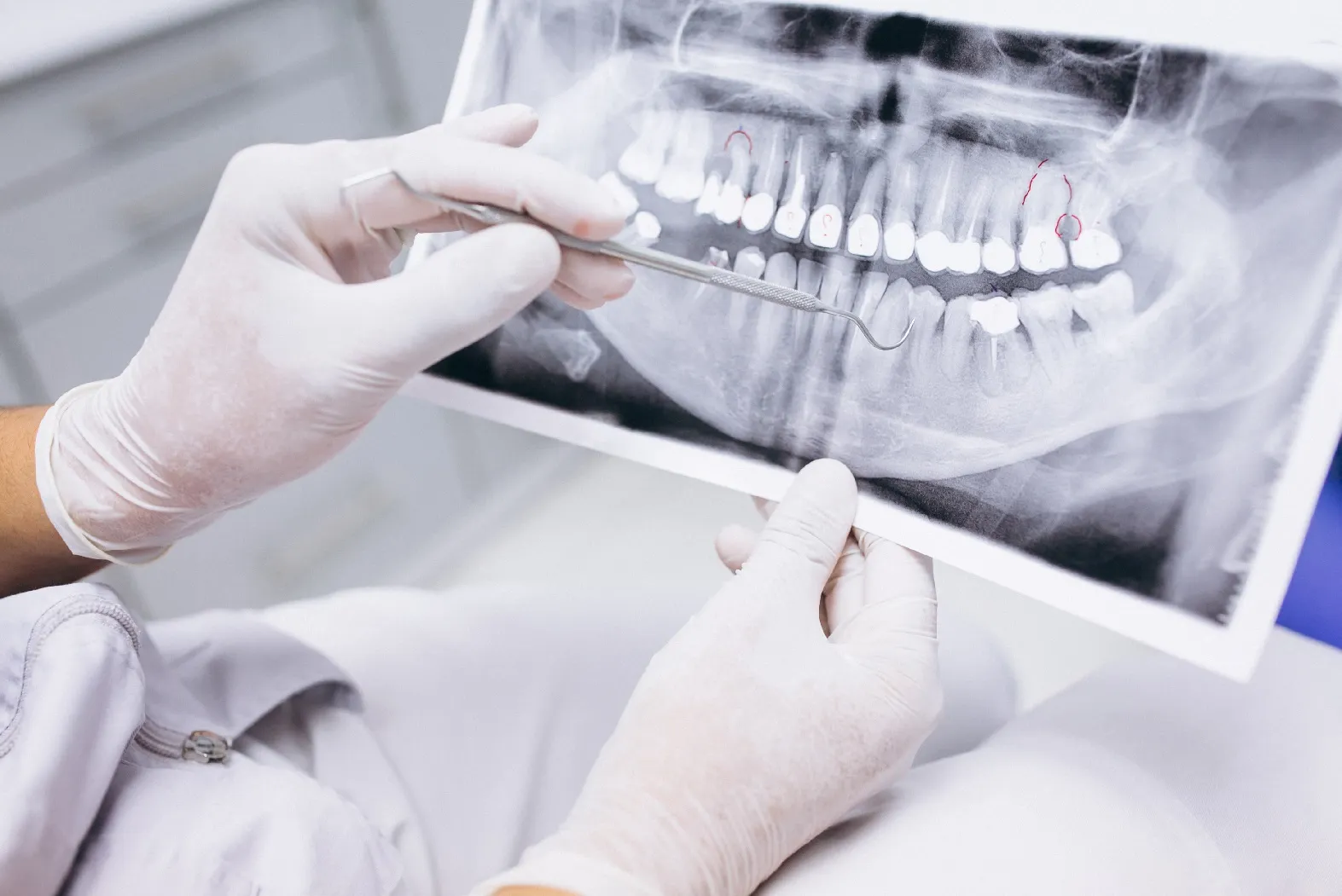 خطوات زراعة الاسنان