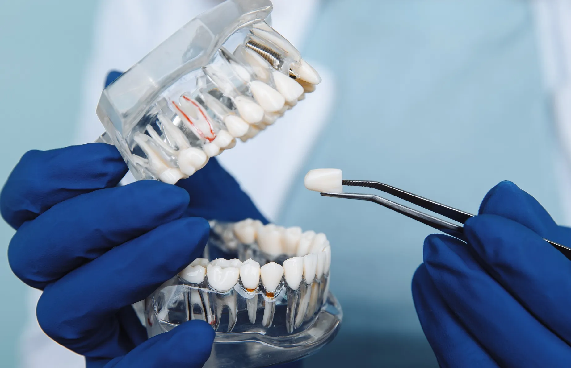 خطوات زراعة الضرس