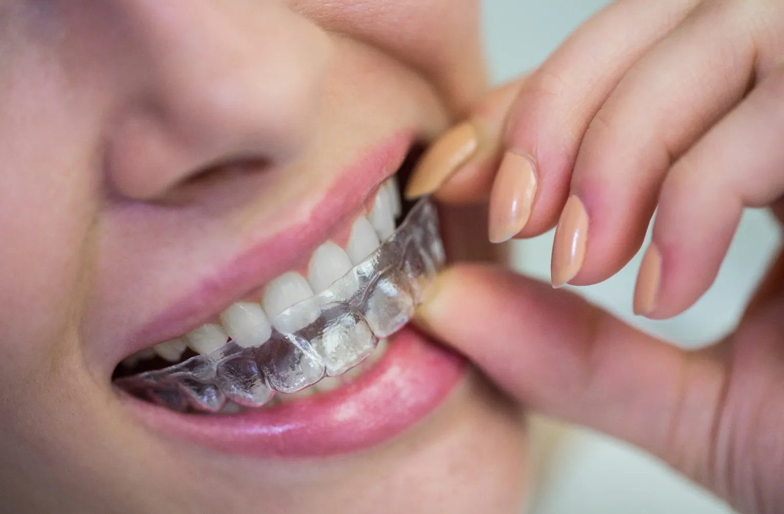 رفع اللثه بدون جراحة