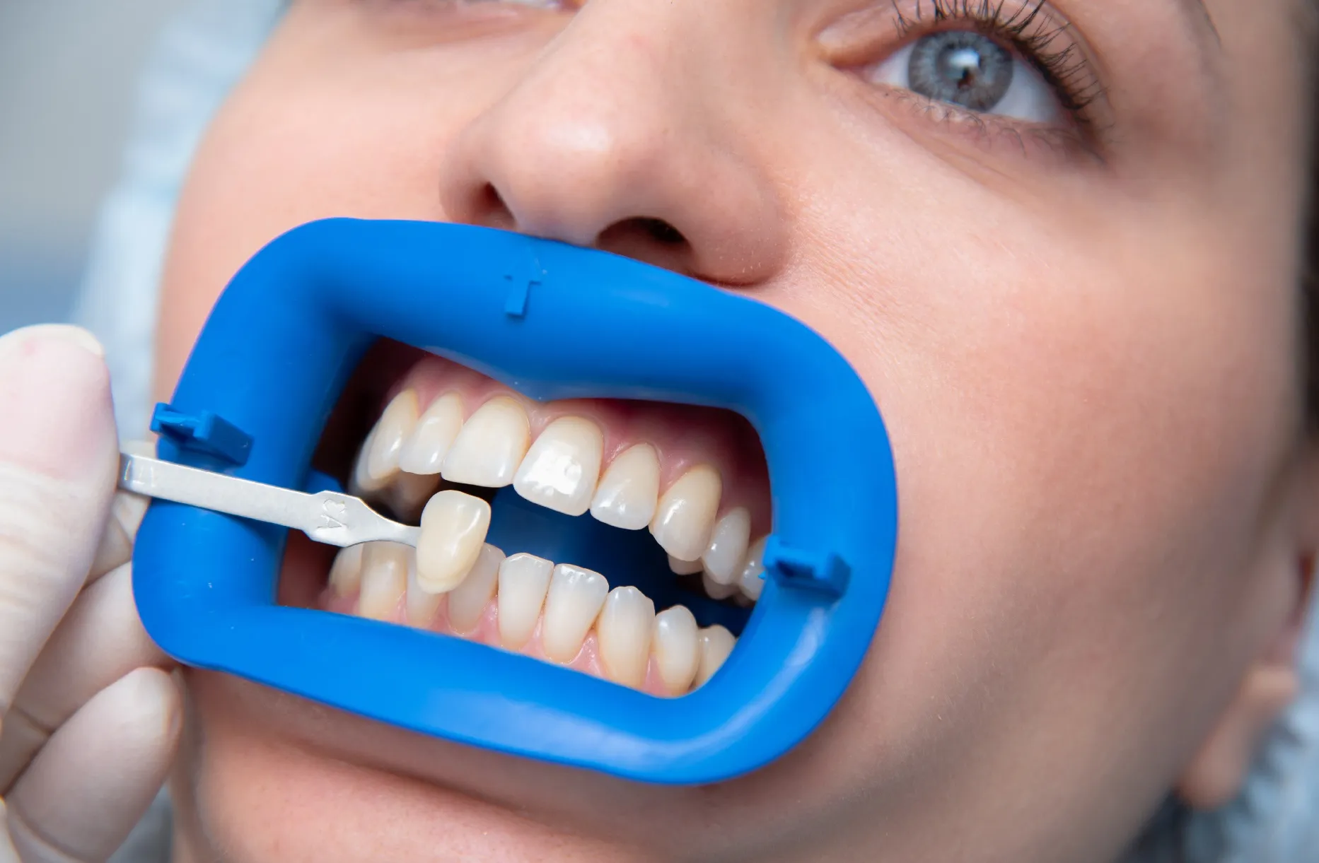 زراعة الأسنان