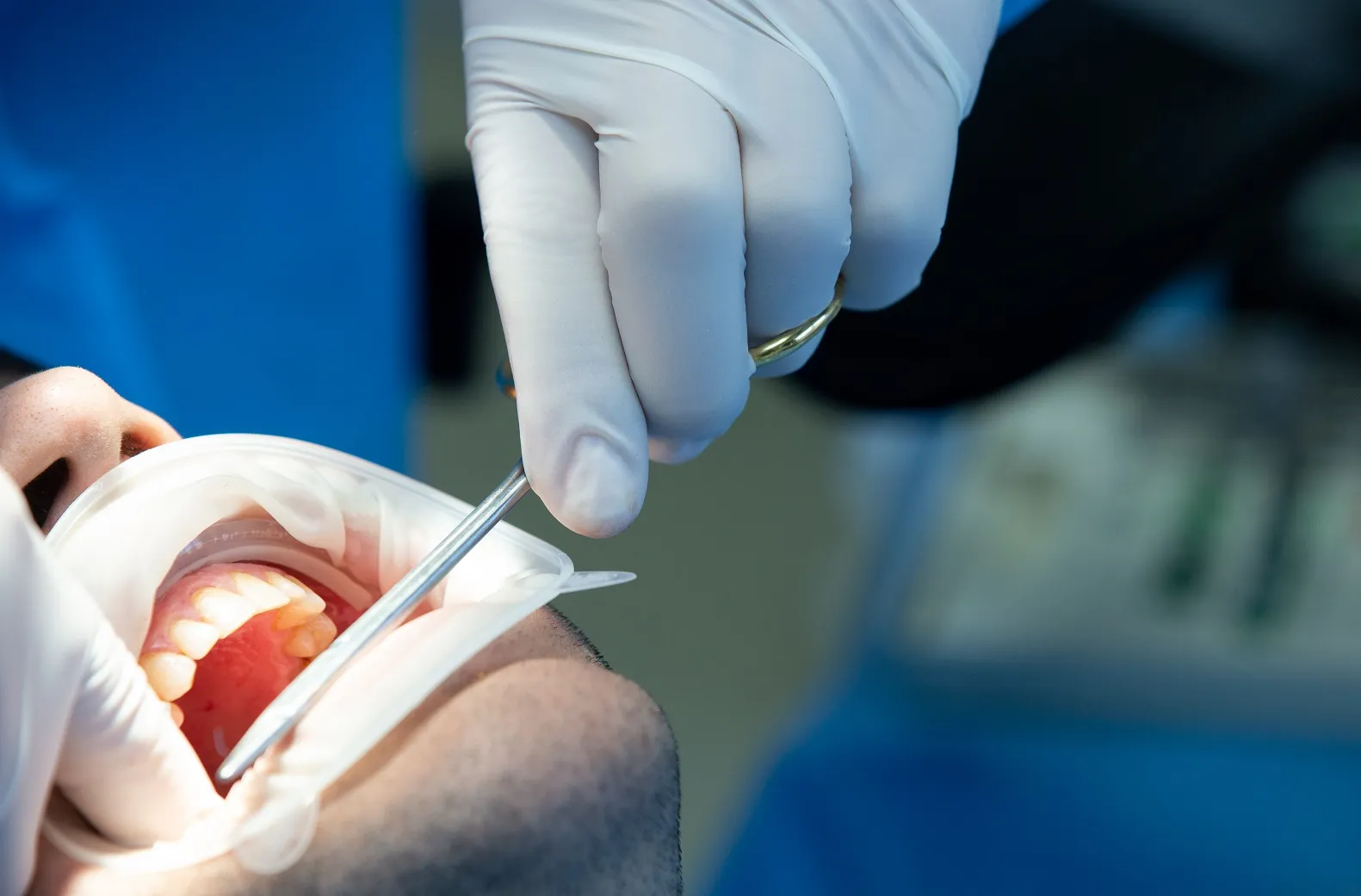 زراعة الاسنان