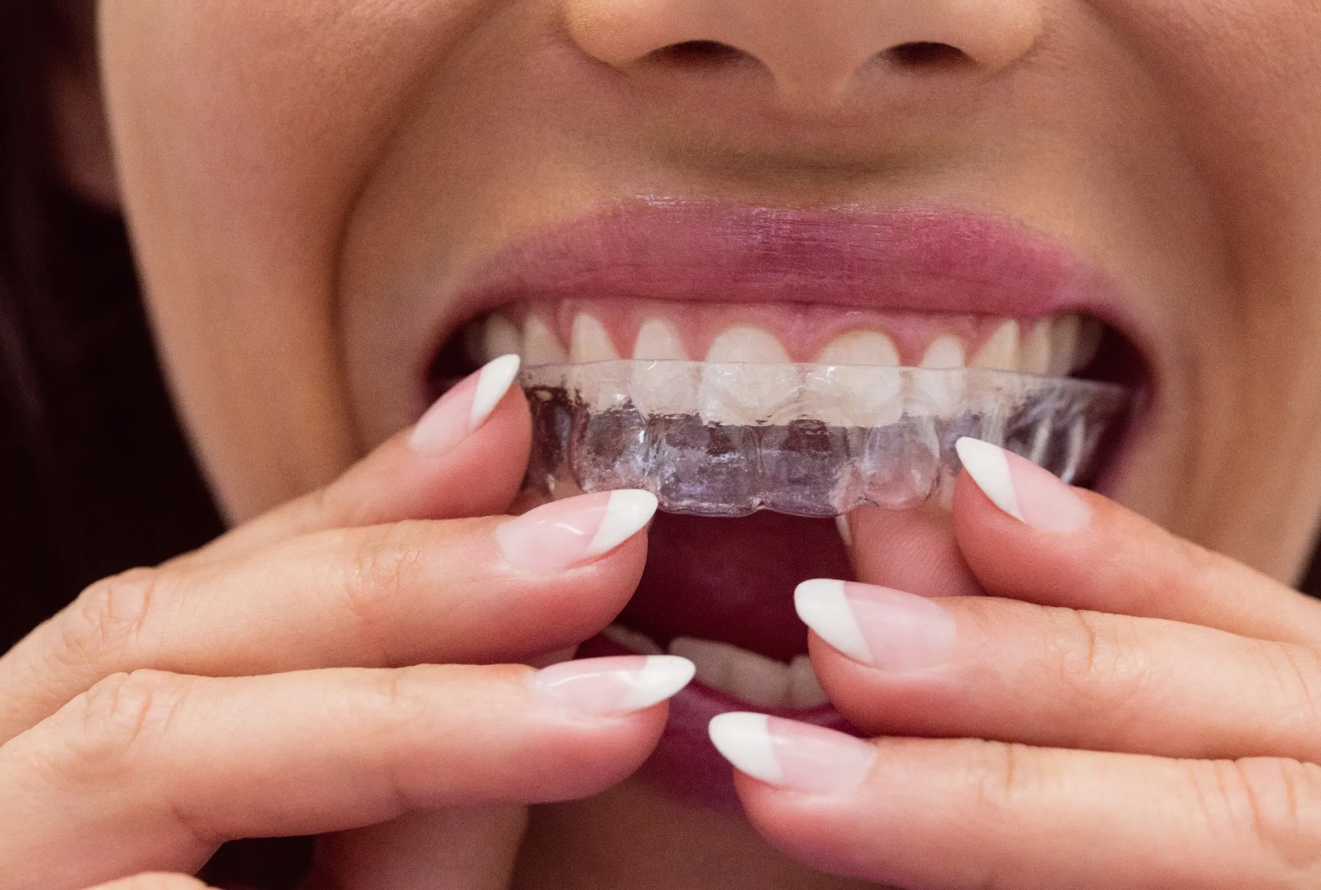 طرق زراعة الأسنان بالليزر