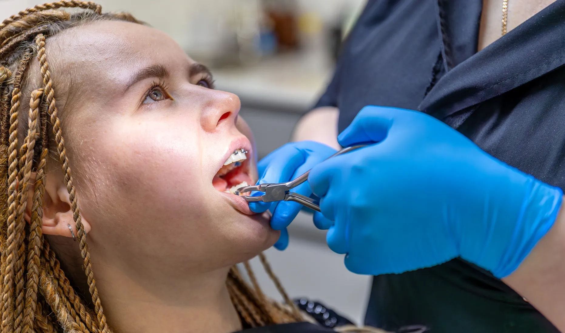 علاج الأسنان المكسورة