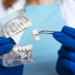 مرضى زراعة الأسنان