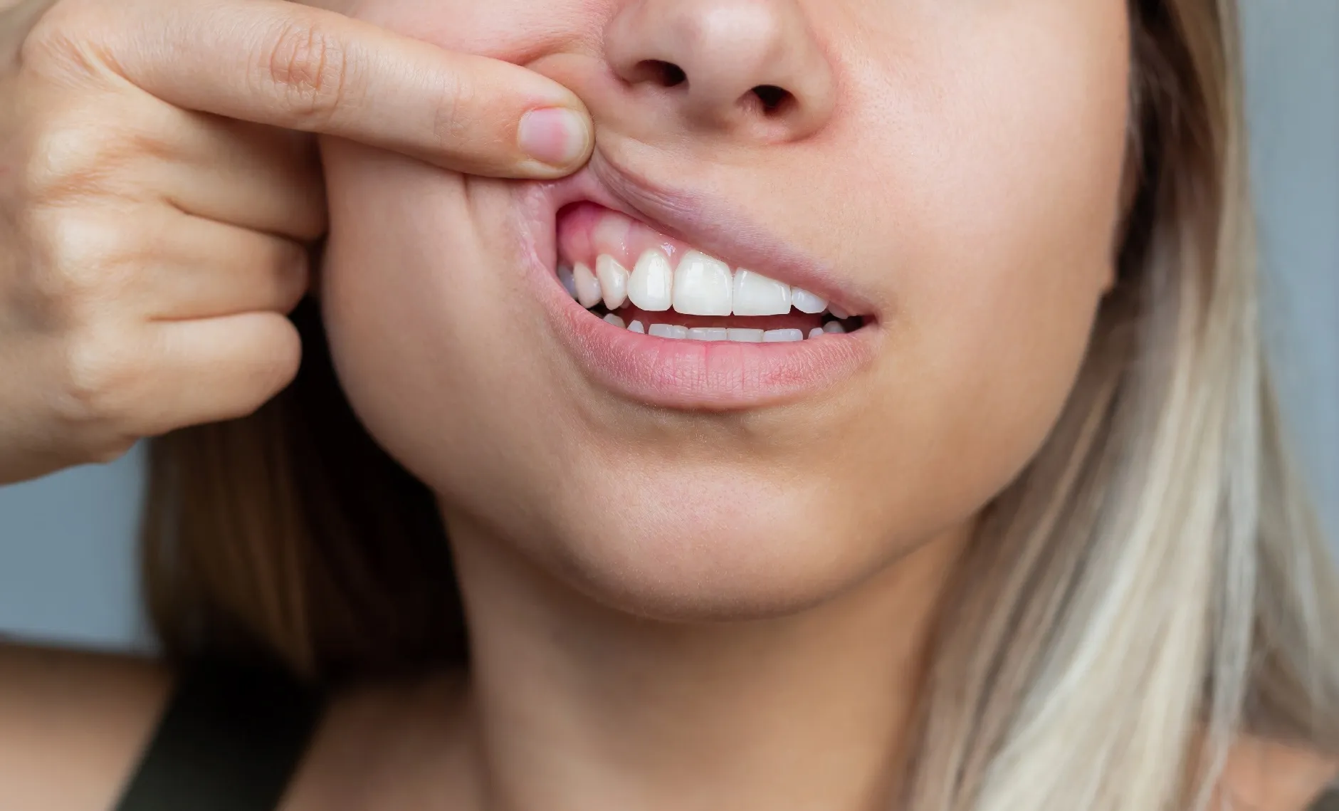 اعراض تصبغات اللثة