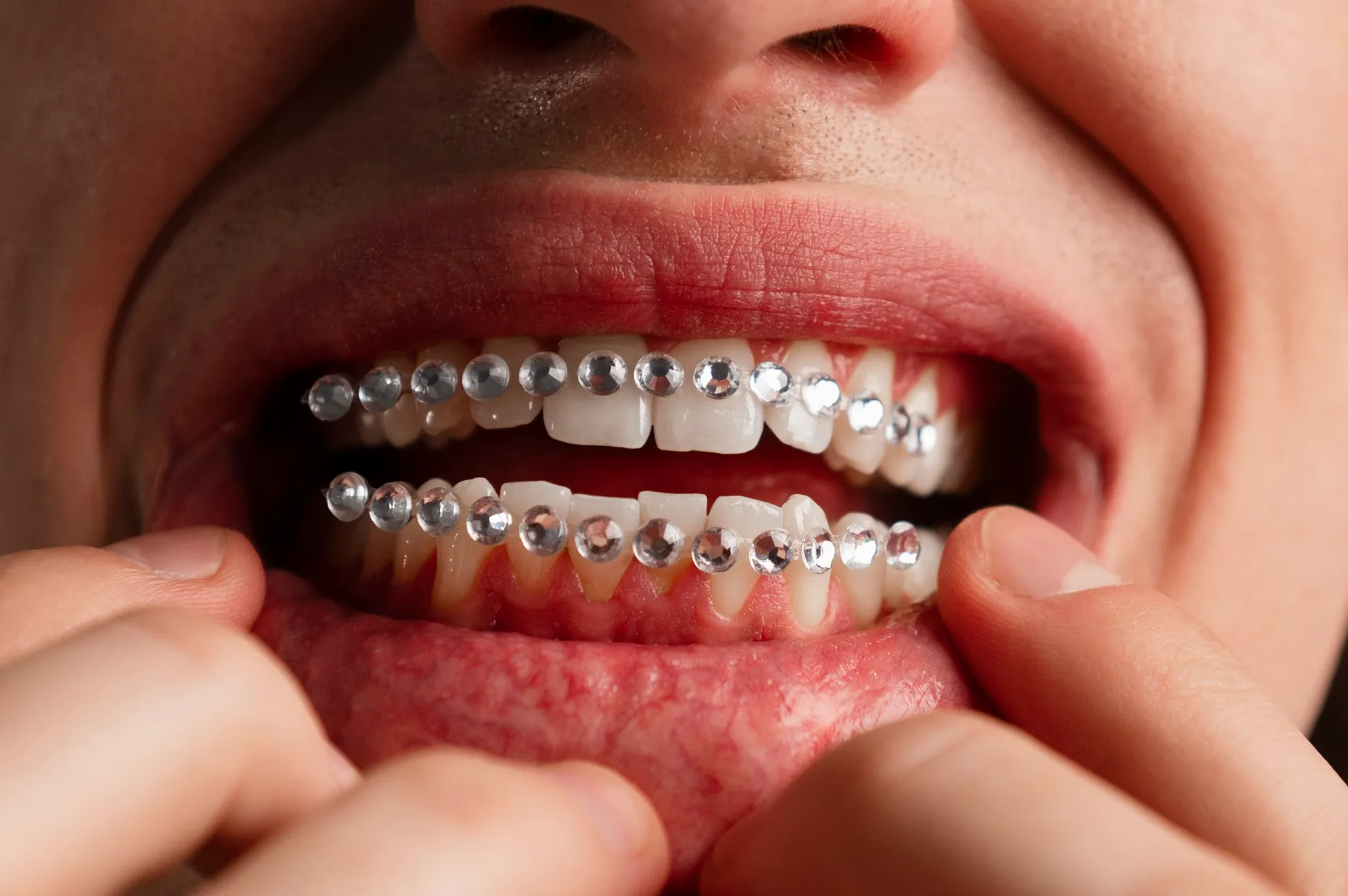 الأسنان المزروعة