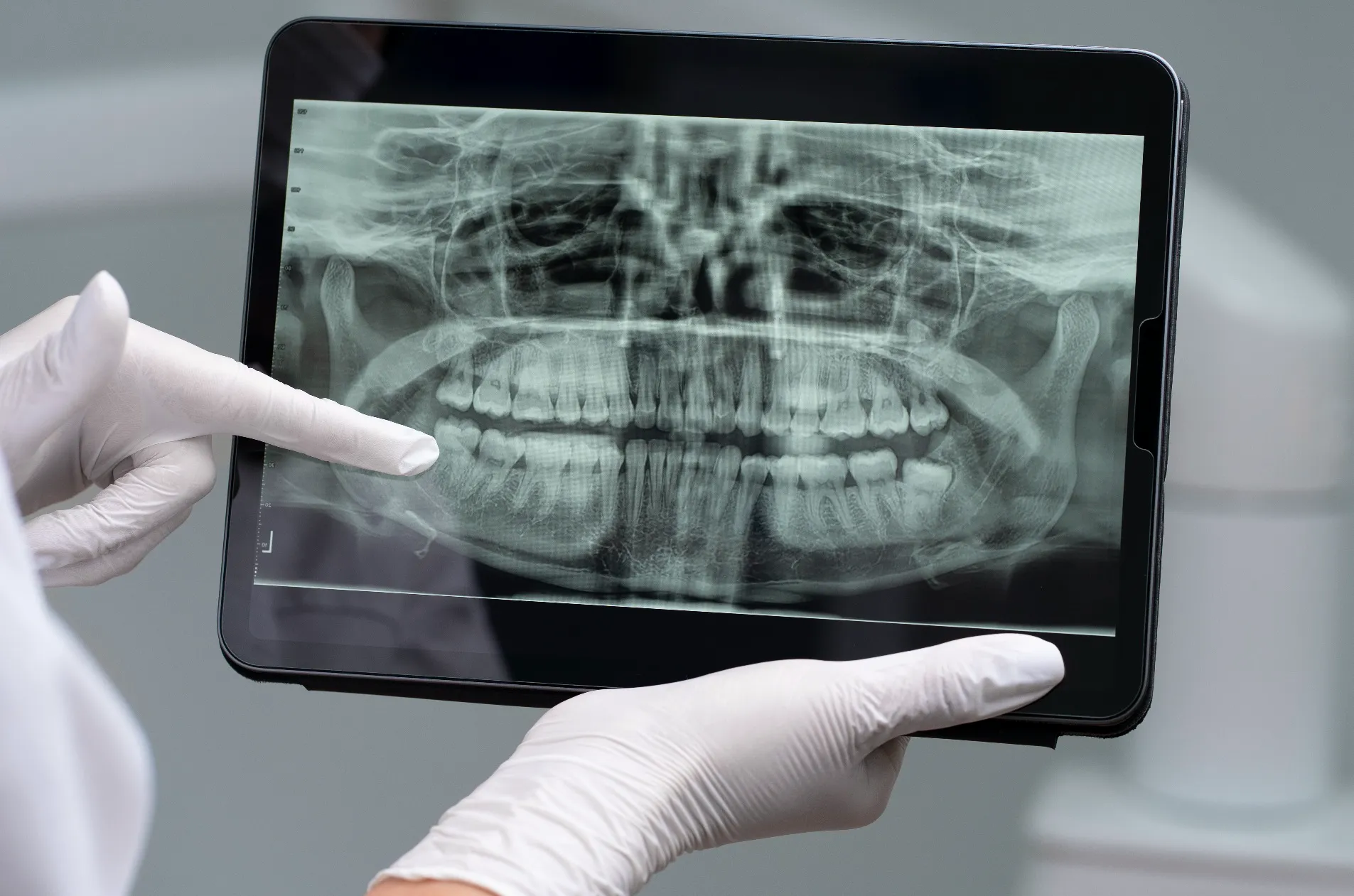 سلبيات إجراء زراعة الأسنان الفورية