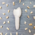 أفضل أنواع الأسنان للزراعة