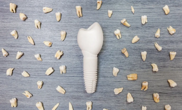 أفضل أنواع الأسنان للزراعة