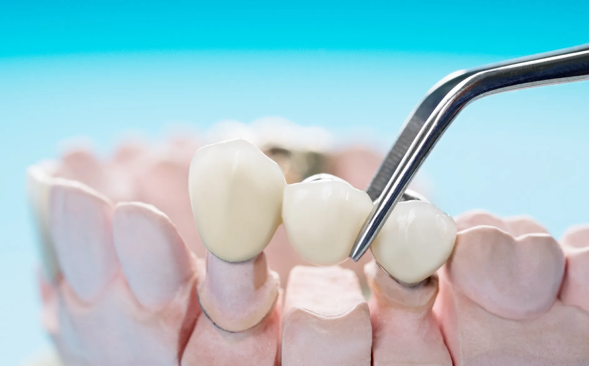 أنواع خلع الأسنان