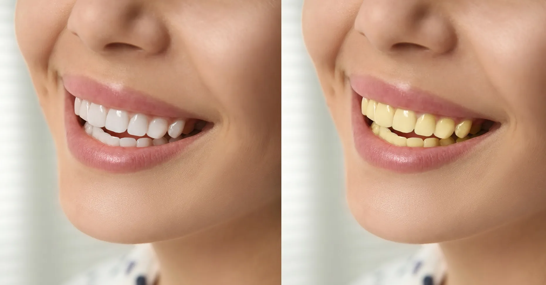 إزالة تصبغات الأسنان