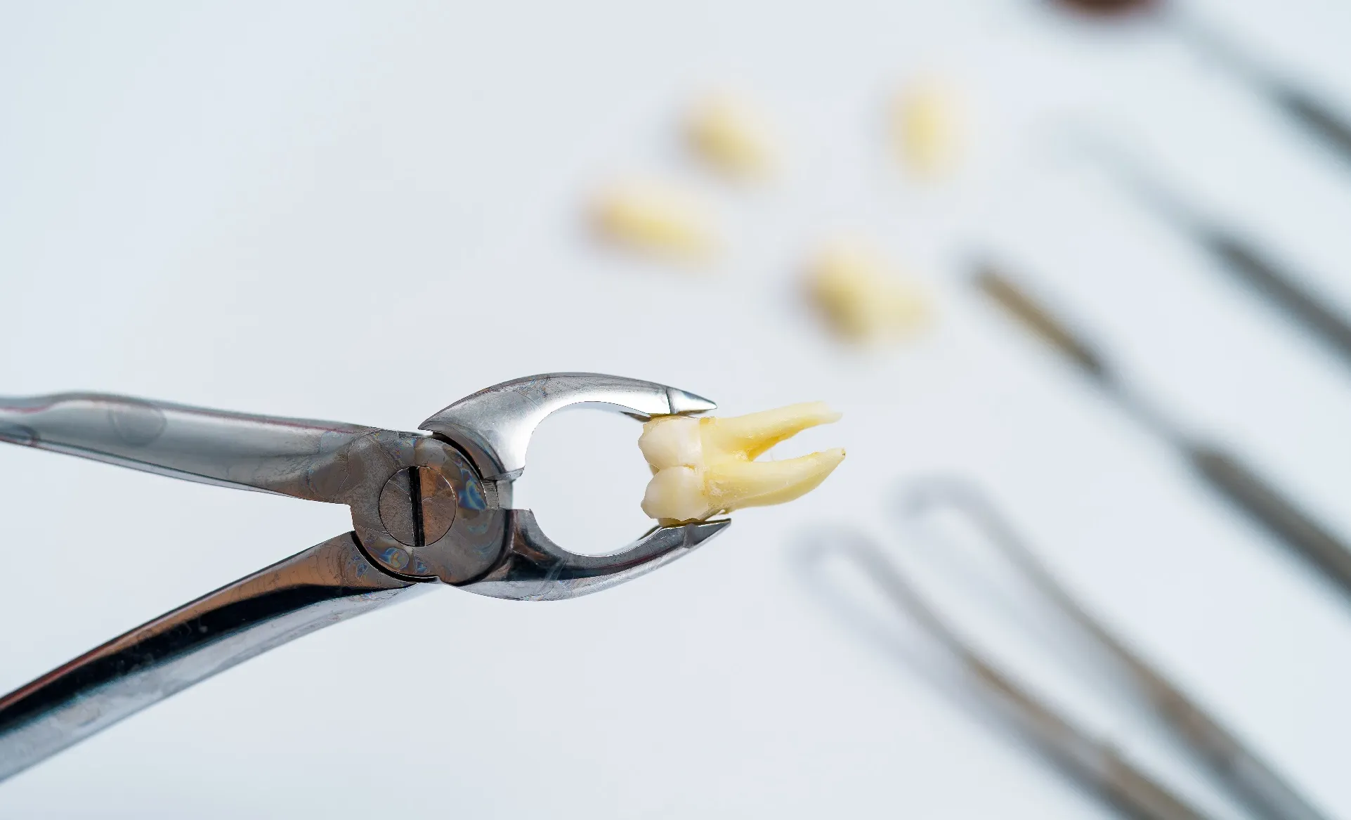 خلع الاسنان