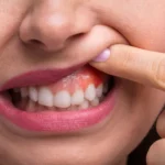 علاج تصبغات اللثة