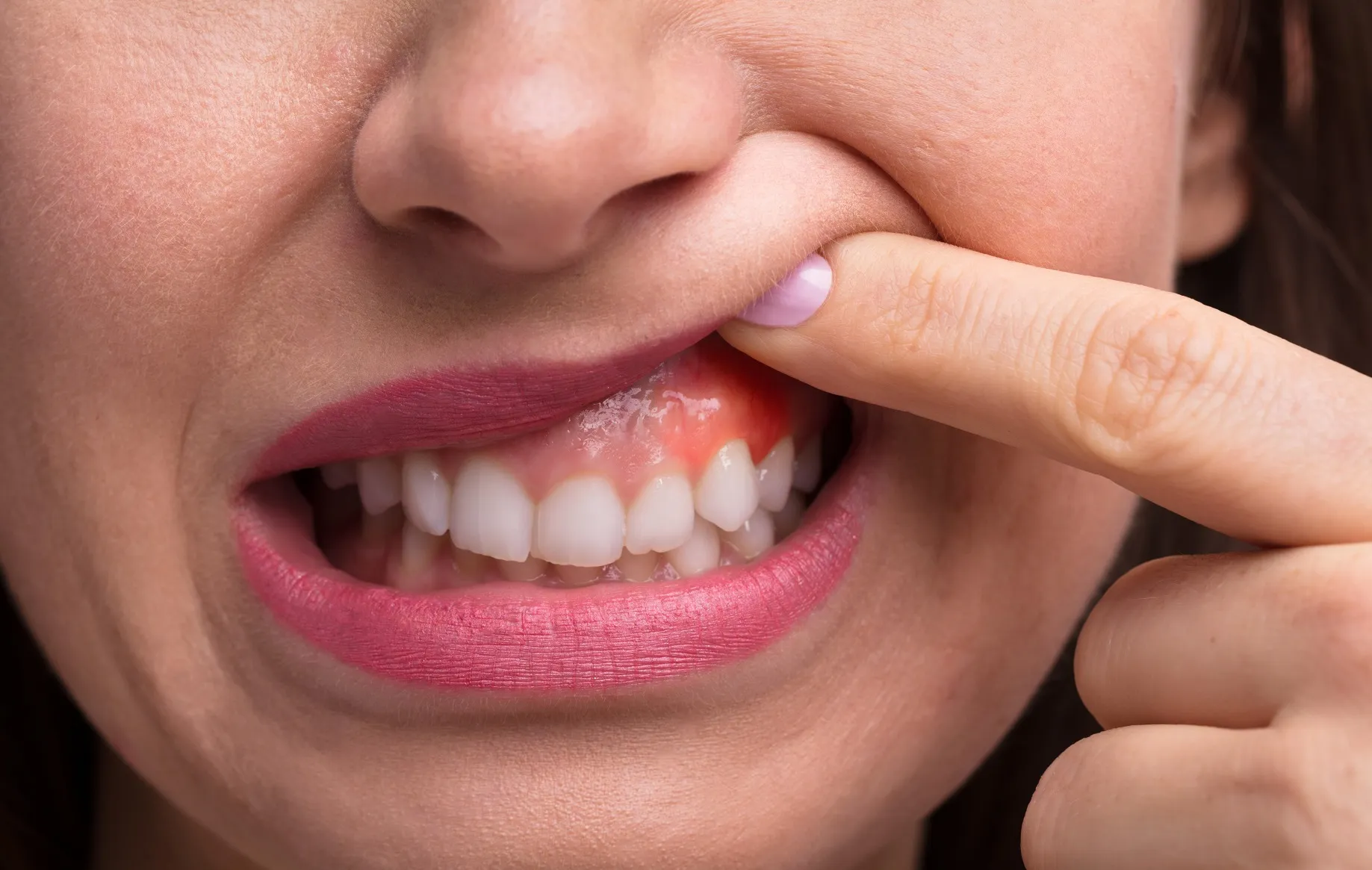 علاج تصبغات اللثة