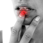 أنواع أمراض الفم