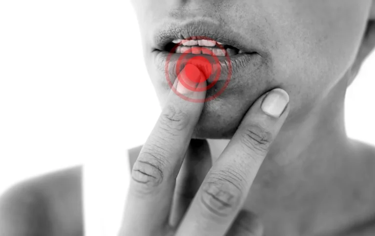 أنواع أمراض الفم