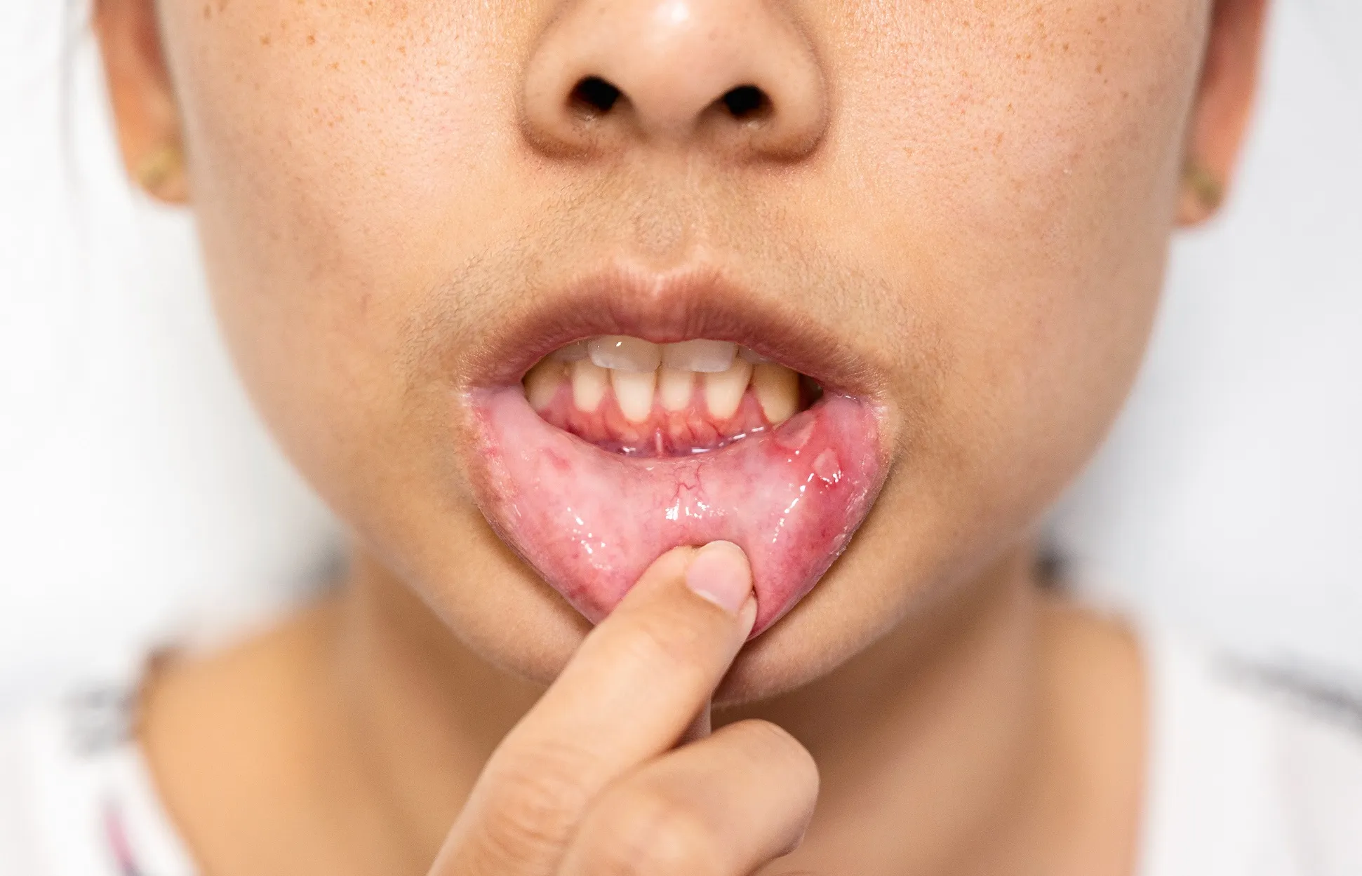 التهابات اللثة