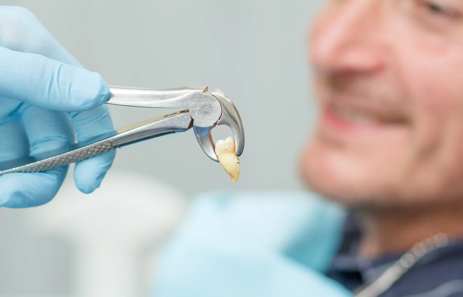 الخلع الجراحي للسن