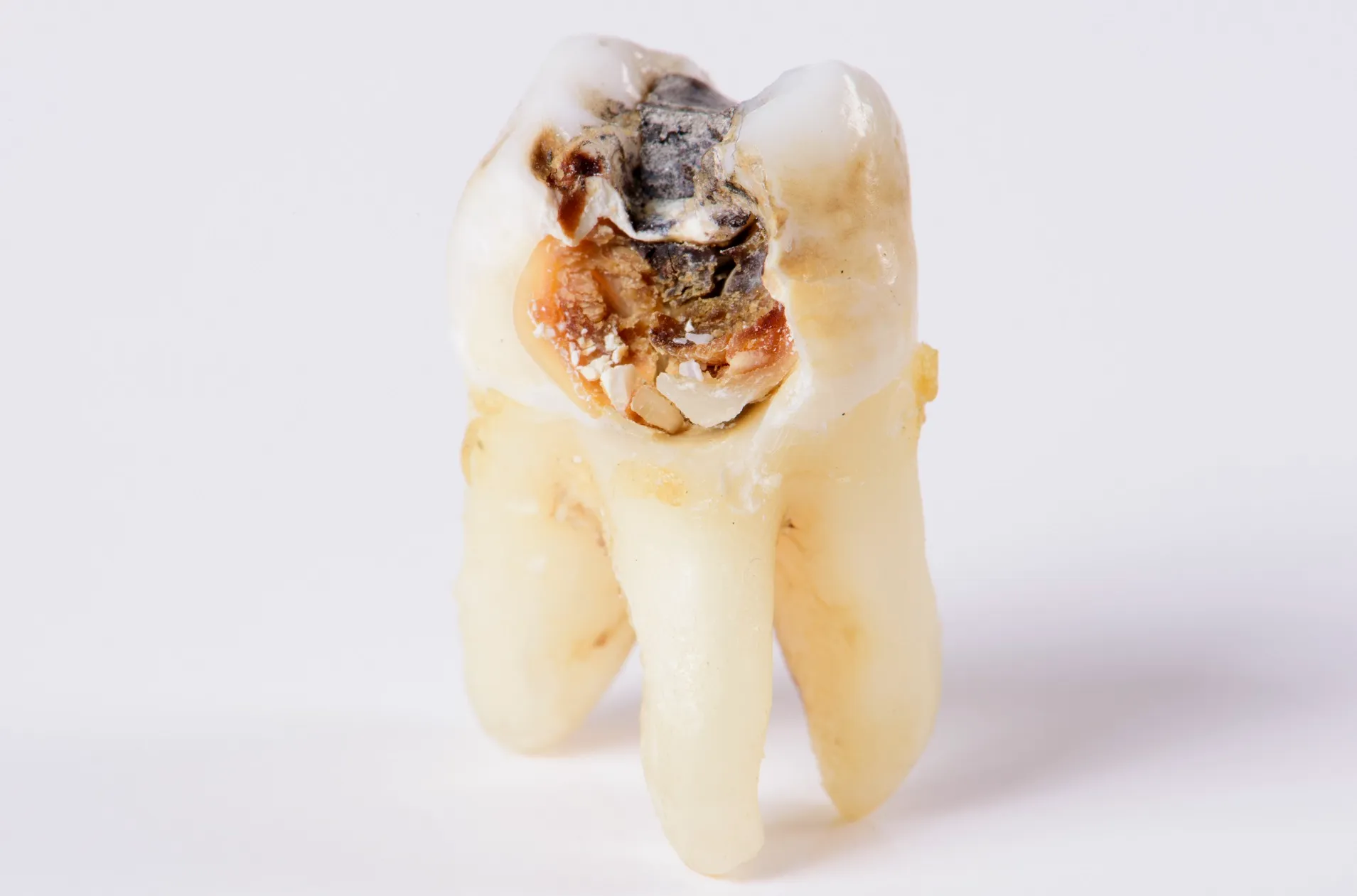 تسوس الأسنان