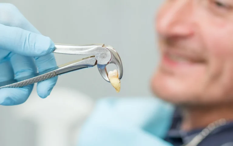 طريقة خلع الاسنان