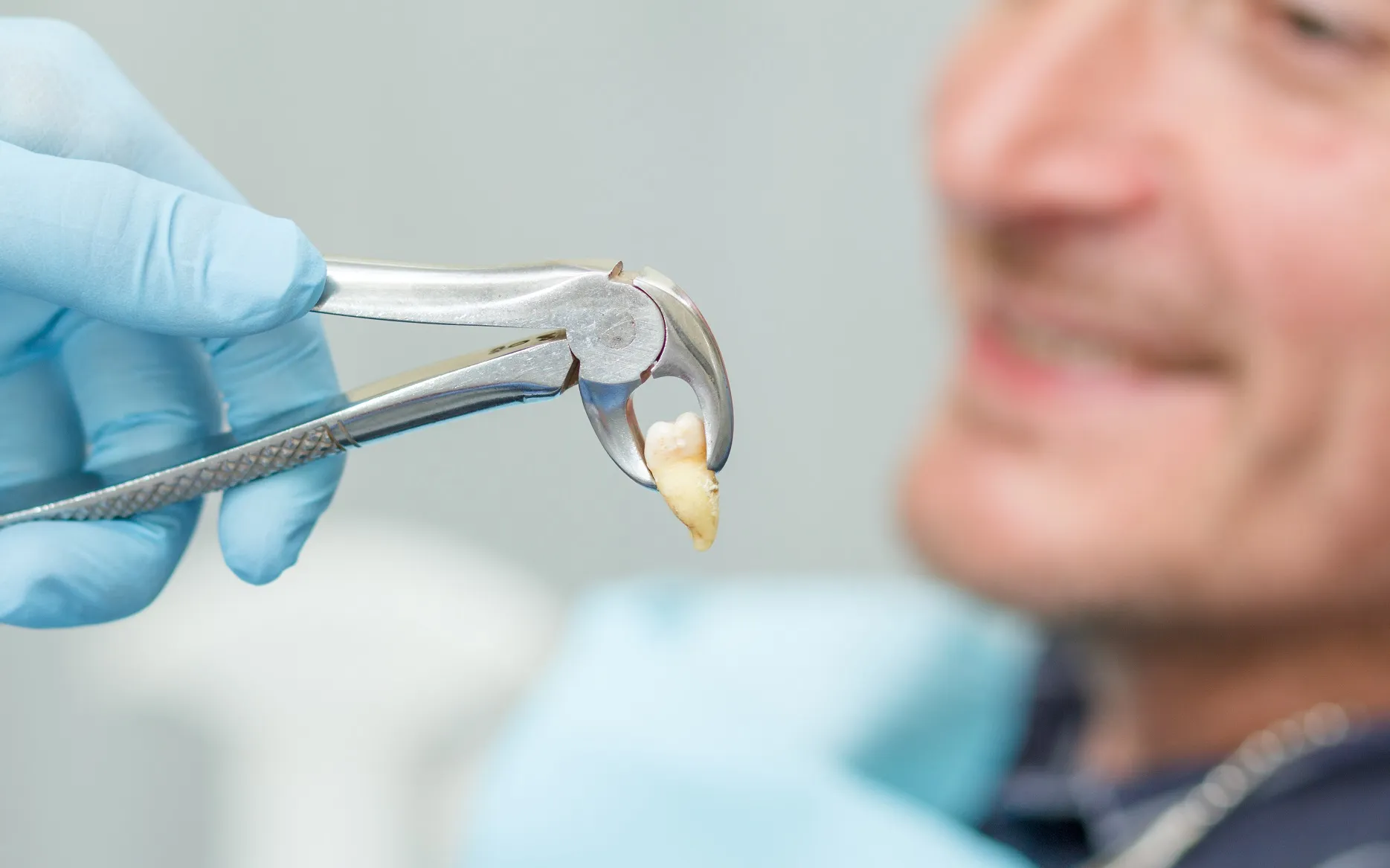 طريقة خلع الاسنان