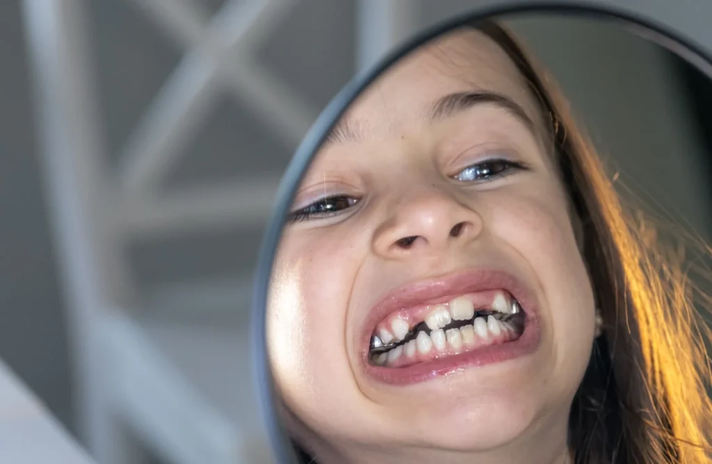 الاسنان المكسورة