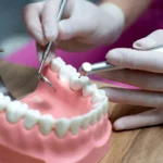 زراعة الأسنان