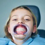 إعادة تأهيل الفم بالكامل