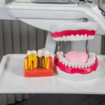 الفرق ما بين السيراميك والزيركون