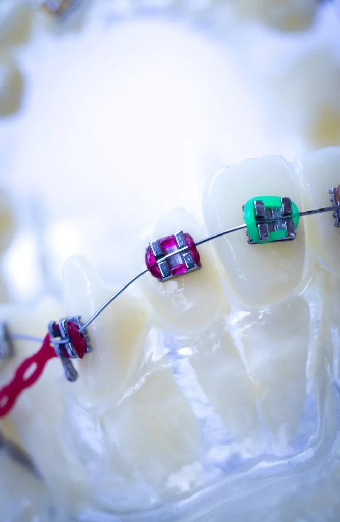 تقويم الأسنان اللاصق