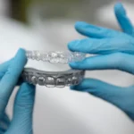 تقويم الأسنان اللاصق خلف الأسنان