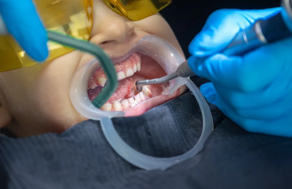 تنظيف الأسنان