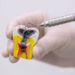 مضاعفات حشو الجذور