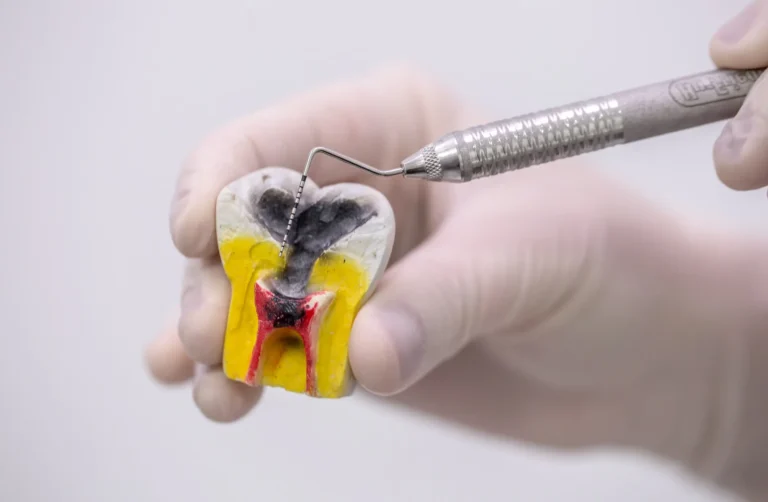 مضاعفات حشو الجذور