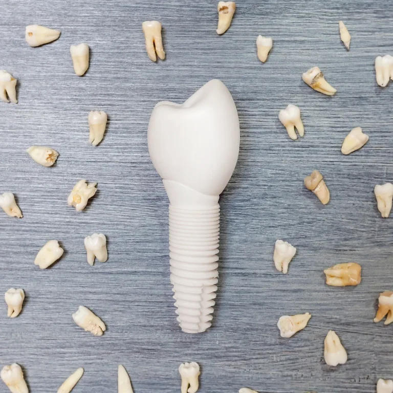 أفضل أنواع الأسنان للزراعة