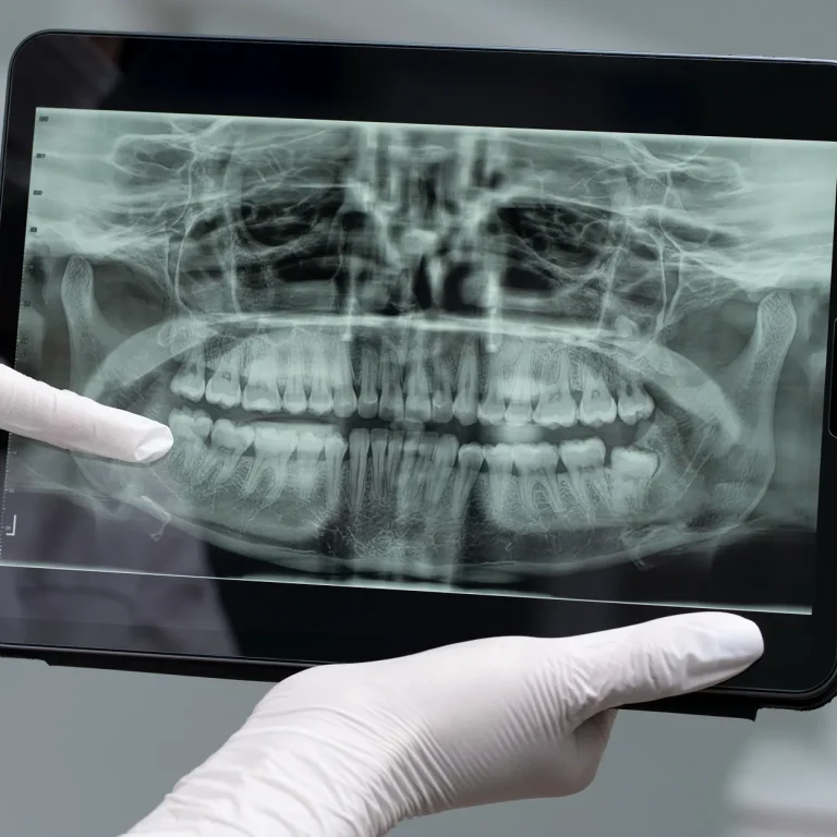 اشعة بانوراما الاسنان