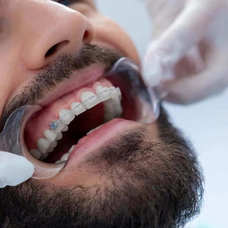 ترقيع اللثة