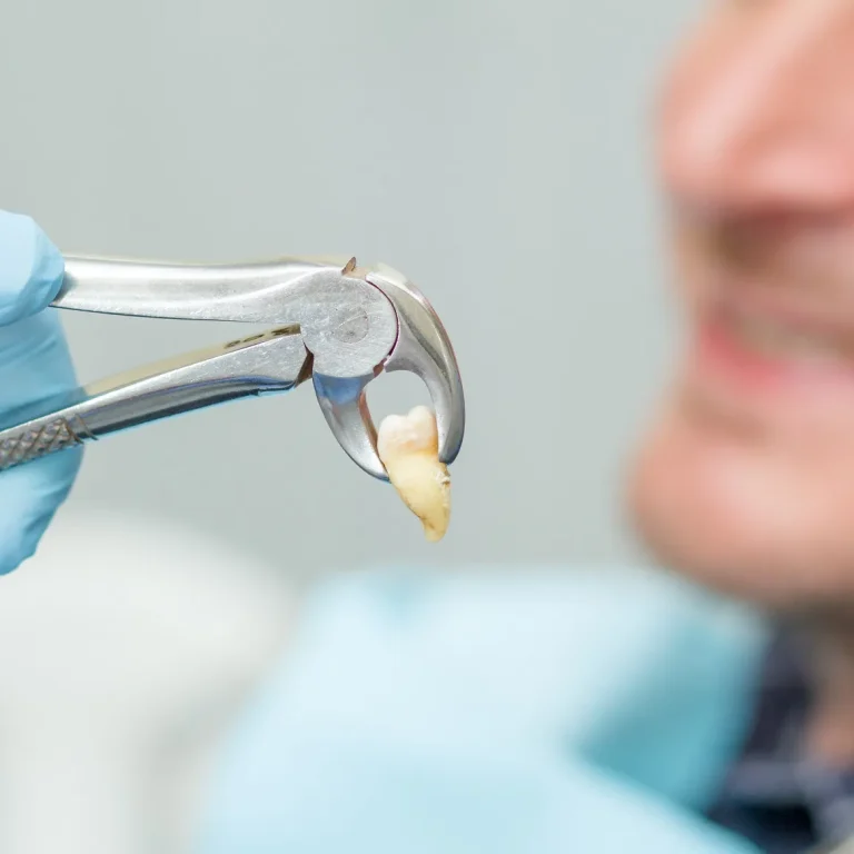 طريقة خلع الاسنان