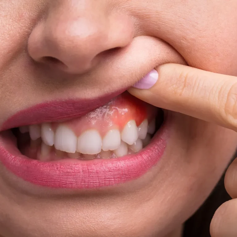 علاج تصبغات اللثة