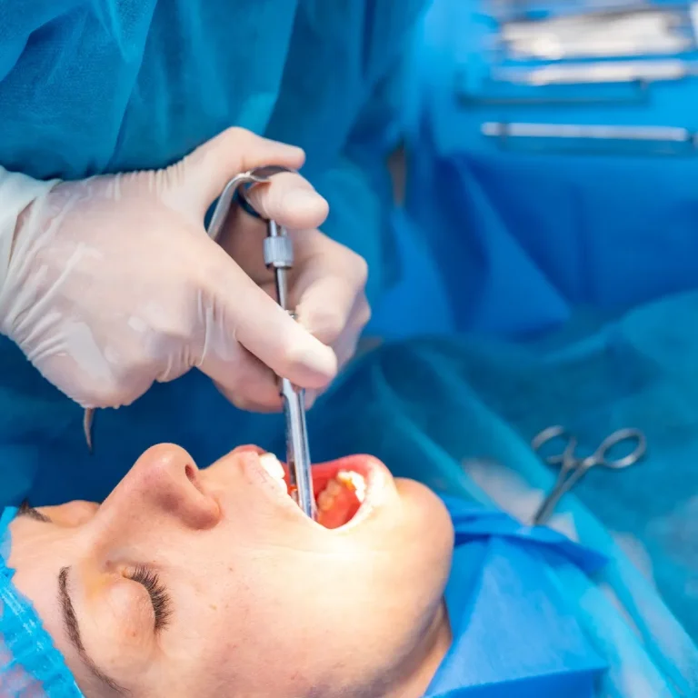 عملية زراعة اللثة